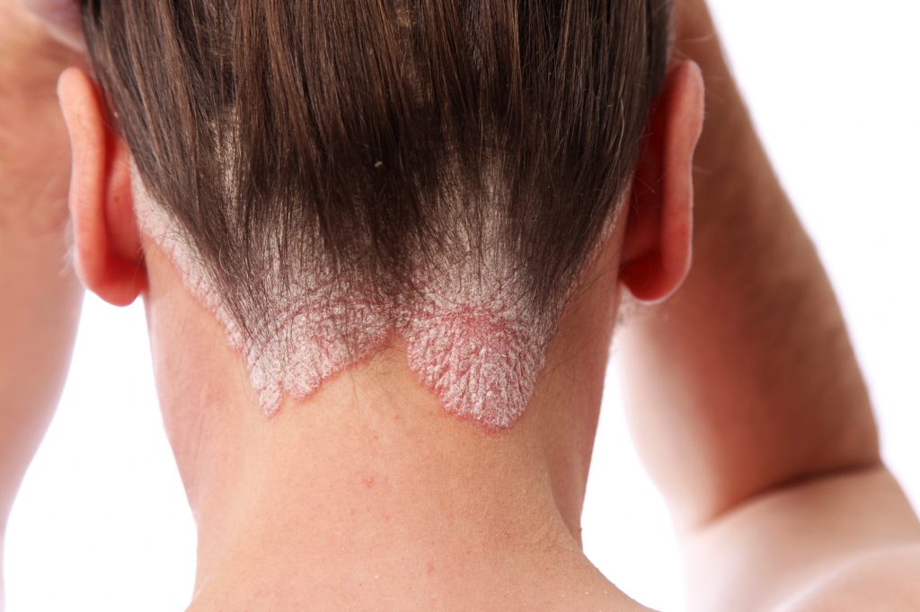 Role of Yashtimadhu (Glycyrrhiza glabra) in psoriasis: A mechanistic and therapeutic overview